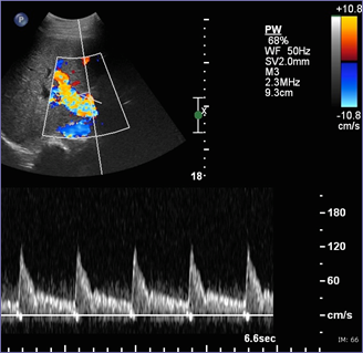 10-2-10 HA post angioplasty, lower RI.jpg