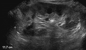 pre stent US 3 kidney w ureteral stent