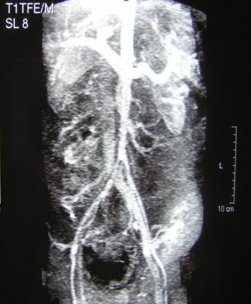 Demetrious-1 MRI with AVF