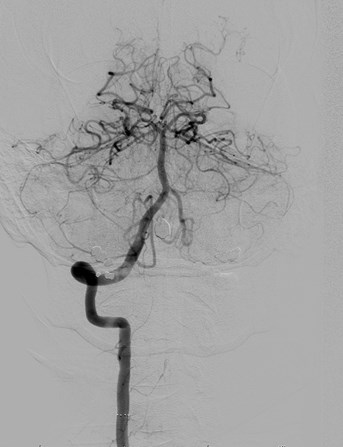 angio post stent injection 2.jpg