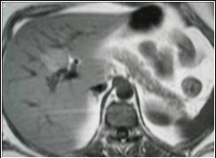 Learningradiology Com Mri Of Abdomen