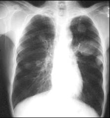 LearningRadiology-Recognizing CHF