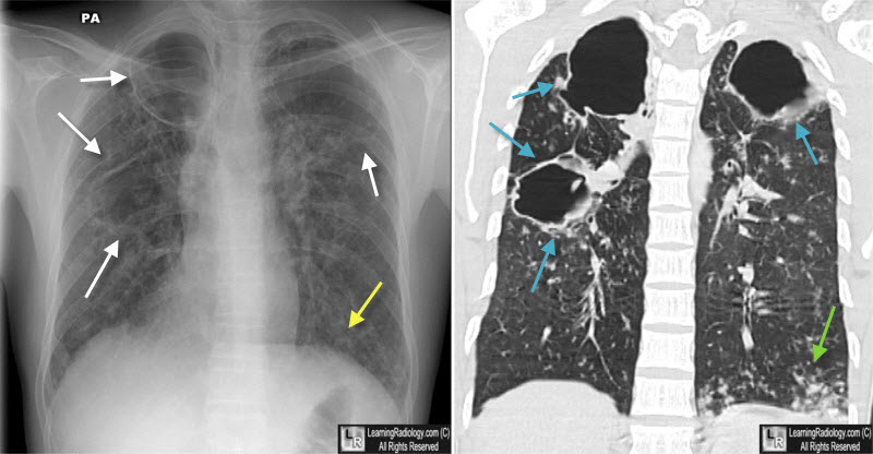 Learningradiology Tb Tuberculosis