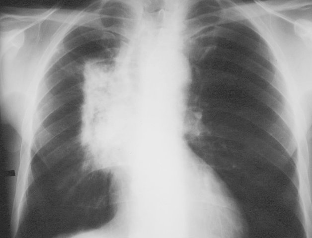 Radiation Pneumonitis