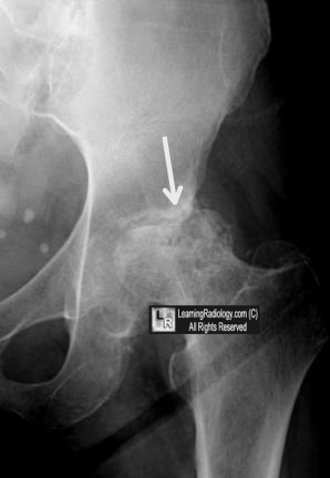 Welcome to LearningRadiology - radiology, radiologic ...