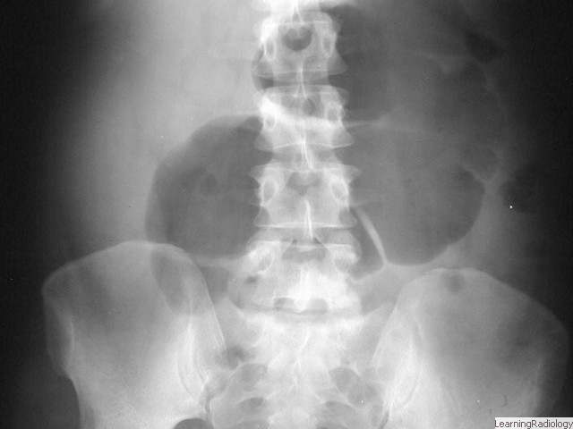 Large Bowel Obstruction-Cecal Volvulus. Dilated loop of large bowel (cecum) is seen in the left upper quadrant. Since this is a proximal LBO, little gas is seen in large bowel. Much less common than sigmoid volvulus.