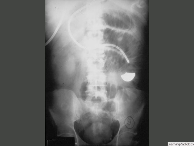 Gallstone Ileus. Really a type of SBO. Look for dilated loops of small bowel and air in bile duct from fistula that allows gallstone to enter bowel. Gallstone usually not visible but is seen here overlying right ilium.