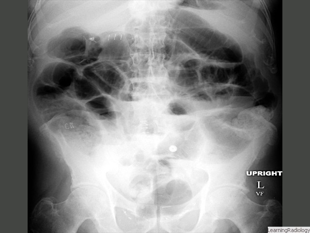 Generalized Ileus. All loops of bowel, large and small, are dilated. Generalized ileus occurs in post-operative patients or those with electrolyte imbalance. Gas will be present in large bowel and rectosigmoid.
