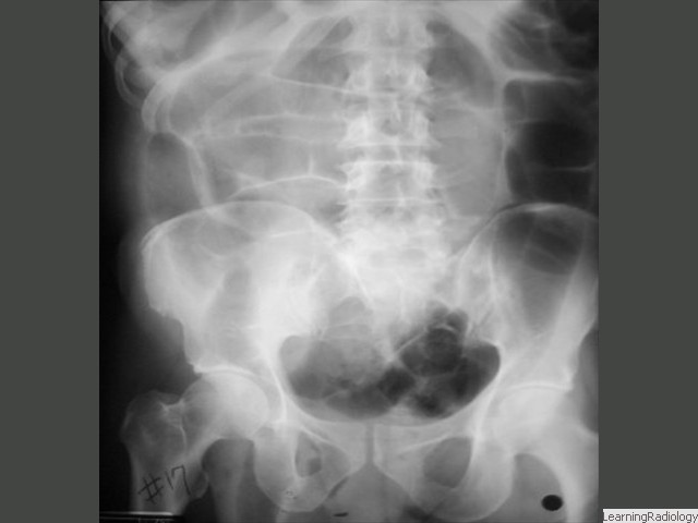 Small Bowel Obstruction-from Incarcerated Inguinal Hernia. There should normally be no bowel gas seen over obturator foramina. There is an obstructing right-sided inguinal hernia.