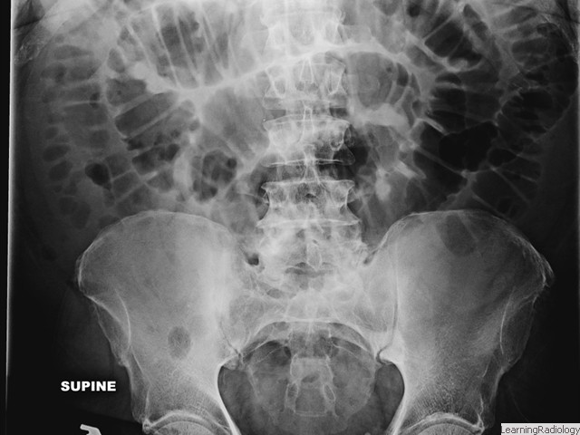 Small Bowel Obstruction. Multiple dilated loops of small bowel with little or no gas in the large bowel or rectosigmoid. Usually caused by adhesions. Note valvulae stretch from wall to wall.