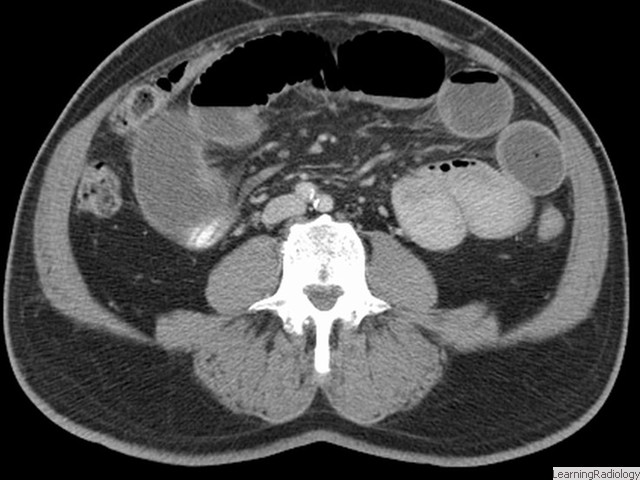 Small Bowel Obstruction-CT. Dilated and fluid filled loops of small bowel are present while the colon is decompressed indicating an obstruction somewhere in the small bowel.