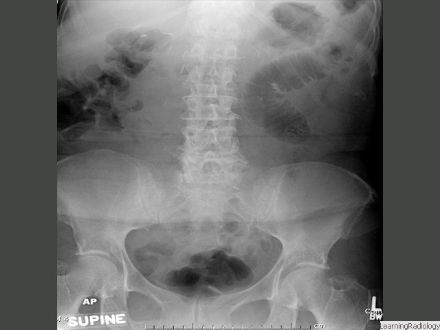 Focal Ileus- Sentinel Loops. One or two persistently dilated loops of small bowel usually adjacent to an area of irritation, such as pancreatitis in this patient. Gas will be present in large bowel and rectosigmoid.