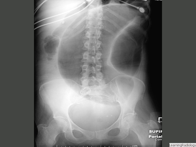 Large Bowel Obstruction-Sigmoid Volvulus. Markedly dilated loop of sigmoid stretches from pelvis into the upper abdomen. Largest loops of dilated bowel occur with volvulus.