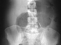 Large Bowel Obstruction-Cecal Volvulus. Dilated loop of large bowel (cecum) is seen in the left upper quadrant. Since this is a proximal LBO, little gas is seen in large bowel. Much less common than sigmoid volvulus.