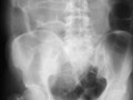 Small Bowel Obstruction-from Incarcerated Inguinal Hernia. There should normally be no bowel gas seen over obturator foramina. There is an obstructing right-sided inguinal hernia.