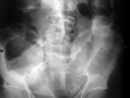 Large Bowel Obstruction. Dilated large bowel down to the level of the sigmoid indicates a distal large bowel obstruction, usually caused by tumor.