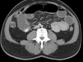 Small Bowel Obstruction-CT. Dilated and fluid filled loops of small bowel are present while the colon is decompressed indicating an obstruction somewhere in the small bowel.