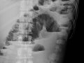 Small Bowel Obstruction-upright view. Multiple air-fluid levels in dilated loops of small bowel, some at different heights in same loop, are seen.