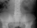 Focal Ileus- Sentinel Loops. One or two persistently dilated loops of small bowel usually adjacent to an area of irritation, such as pancreatitis in this patient. Gas will be present in large bowel and rectosigmoid.