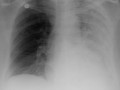 Pneumonia-No shift of heart or trachea. Less homogeneously opaque than effusion or atelectasis. Air bronchograms possible. <br/>