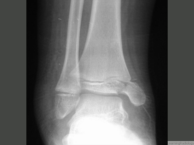 Salter-Harris IV Fracture involving epiphysis, epiphyseal plate and a very small corner of the metaphysis.