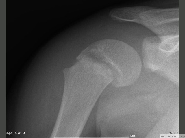Salter I. Occurs through hypertrophic zone of epiphyseal plate. Only epiphyseal plate is fractured. Rarely produces complications. May be difficult to diagnose unless visible displacement of epiphysis on metaphysis. Slipped capital femoral epiphysis (SCFE) is an example of a Salter-Harris I fracture.