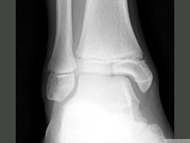 Salter-Harris III. Involves the epiphyseal plate and the epiphysis itself. Since the epiphysis is involved, damage to the articular cartilage can occur. Growth disturbance is uncommon. Tillaux fracture of the ankle is a Salter-Harris III fracture. 
