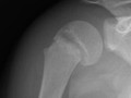 Salter I. Occurs through hypertrophic zone of epiphyseal plate. Only epiphyseal plate is fractured. Rarely produces complications. May be difficult to diagnose unless visible displacement of epiphysis on metaphysis. Slipped capital femoral epiphysis (SCFE) is an example of a Salter-Harris I fracture.