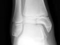 Salter-Harris III. Involves the epiphyseal plate and the epiphysis itself. Since the epiphysis is involved, damage to the articular cartilage can occur. Growth disturbance is uncommon. Tillaux fracture of the ankle is a Salter-Harris III fracture. 