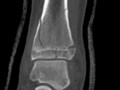 Salter-Harris IV. CT. Involves the epiphyseal plate, metaphysis and epiphysis. 
