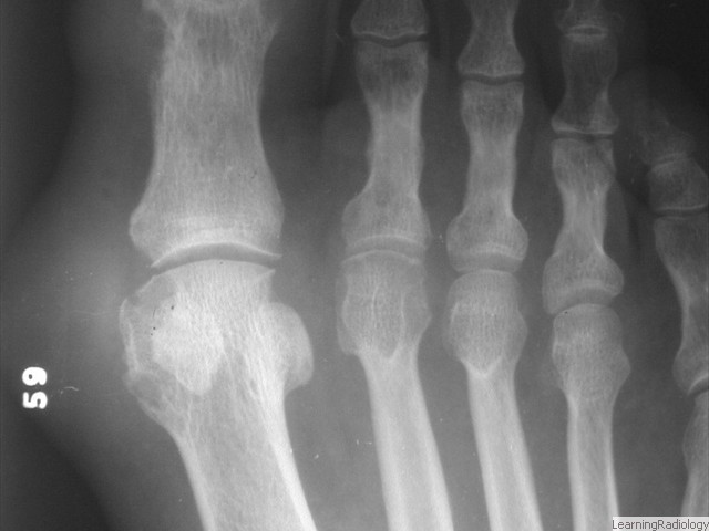 Arthritidies-Foot