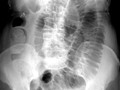 Abnormal Bowel Gas Patterns