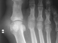 Arthritidies-Foot
