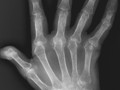 Arthritides-Hands