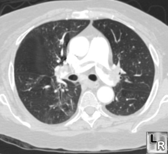 saddle pulmonary embolism xray