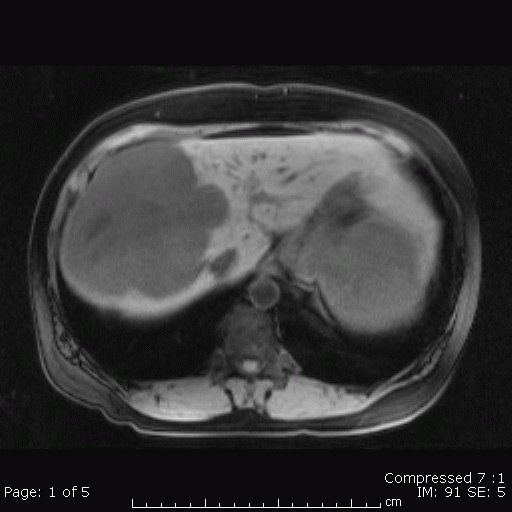 Giant cavernous hemangioma of the liver