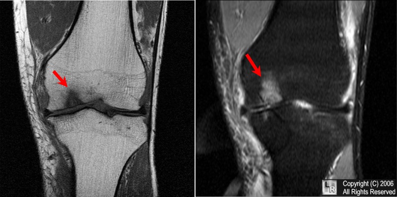 osteochondritis dissecans knee mri vízmegtartó illesztések