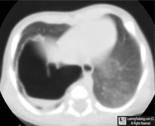 LearningRadiology - Congenital, Cystic, Adenomatoid, Malformation, CCAM ...