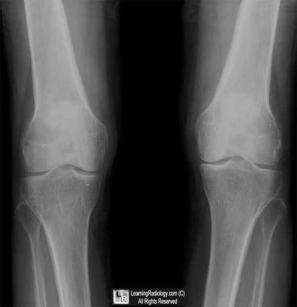 LearningRadiology - Hypertrophic Osteoarthropathy, hoa, hpo