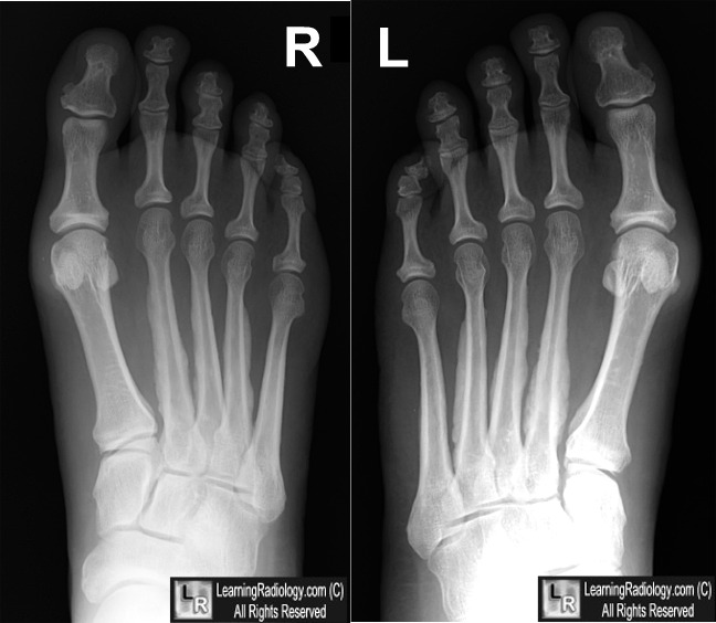 LearningRadiology - Thyroid, Acropachy, foot, hand, clubbing ...