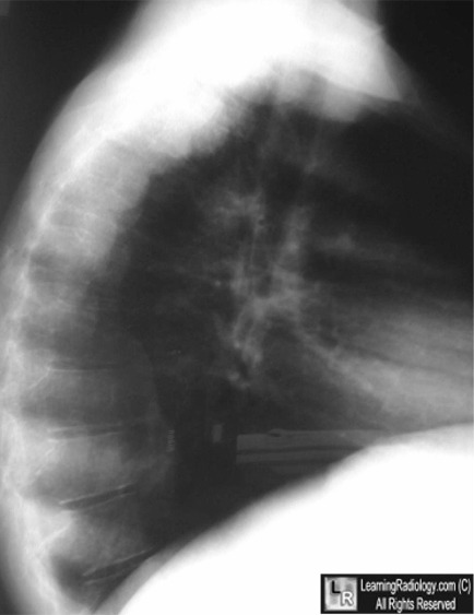 LearningRadiology - Extramedullary, Hematopoiesis, Thalassemia, sickle ...