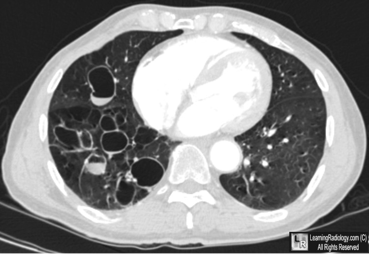 Bronchiectasis: An Evidence-Based Approach to Diagnosis | Current  Pulmonology Reports