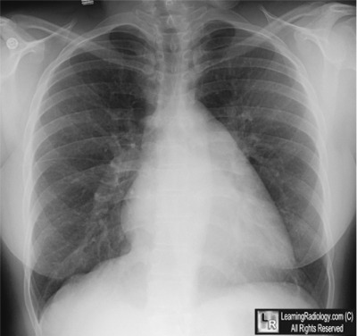 LearningRadiology - mitral, stenosis, ms, stenotic, valve, rheumatic ...