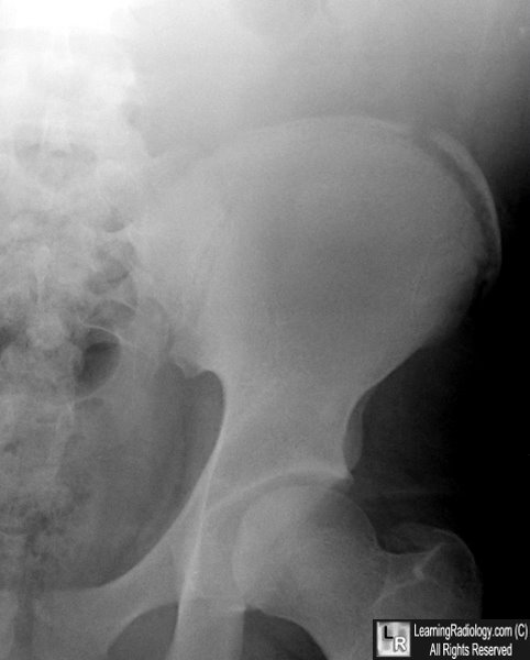 Iliac crest avulsion, Radiology Case