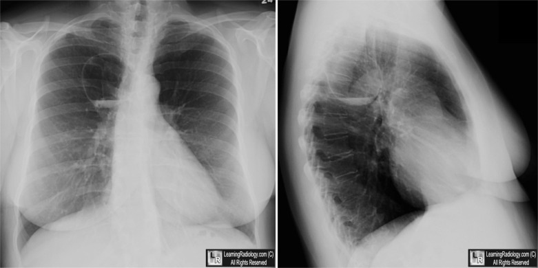 LearningRadiology - infected, bulla, bullous, bullus, disease, air ...