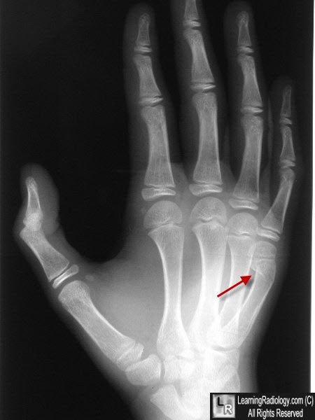 Learning Radiology - Boxer's Fracture