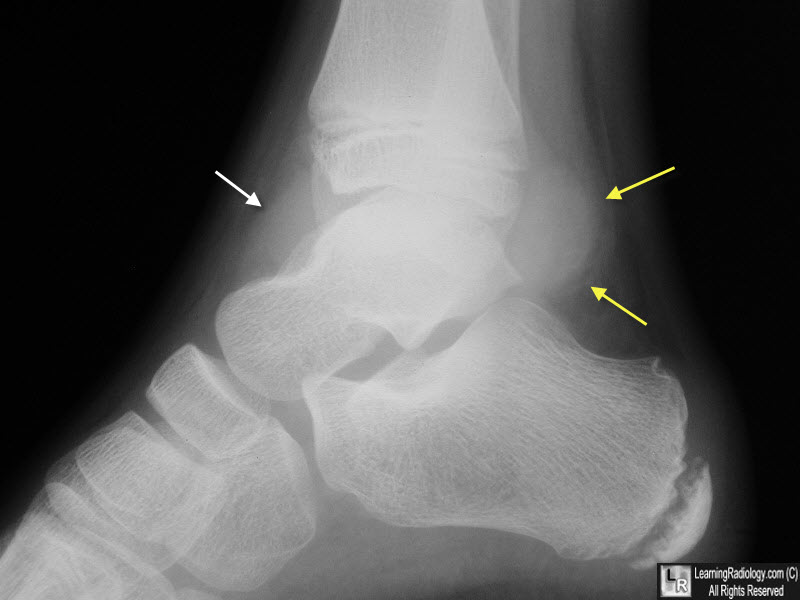 Ankle Joint Effusion.
