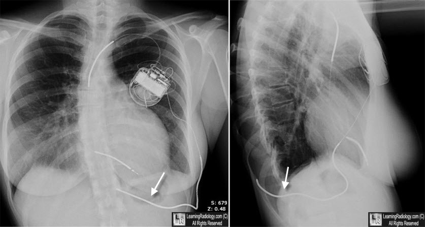 Learning Radiology - Single-coil Subcutaneous Defibrillating Array