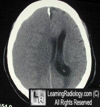 Subacuate subdural hematoma