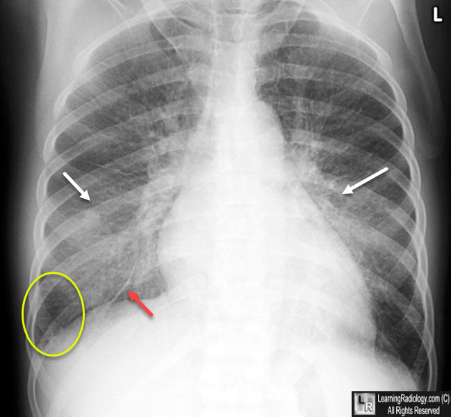 Pulmonary Edema Chf Chest X Ray